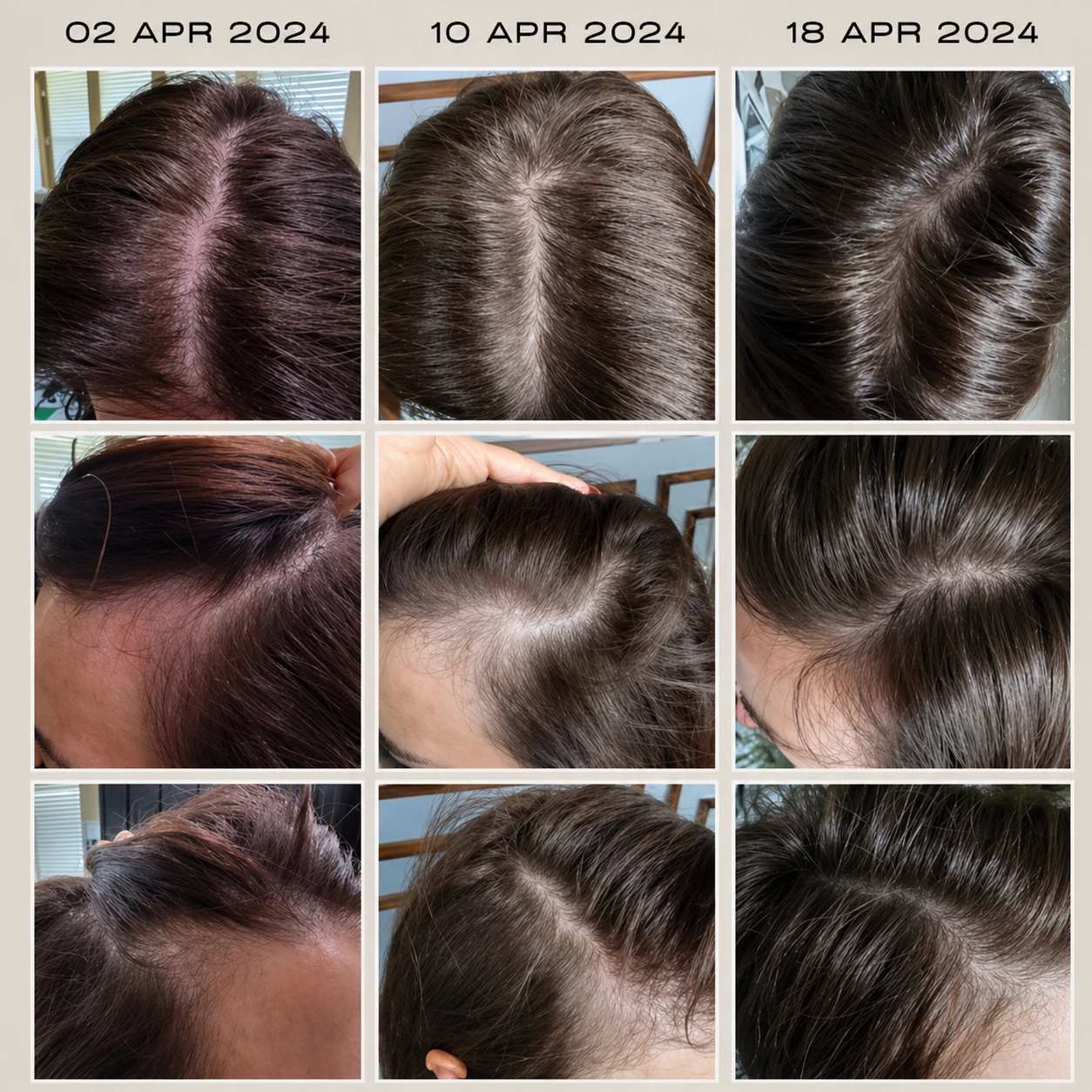 Collage of hair growth progress over a period from 2nd to 18th April 2024.